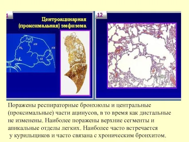 Поражены респираторные бронхиолы и центральные (проксимальные) части ацинусов, в то время как