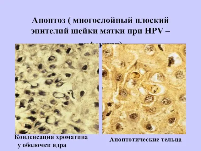 Апоптоз ( многослойный плоский эпителий шейки матки при НРV – инфекции) Конденсация