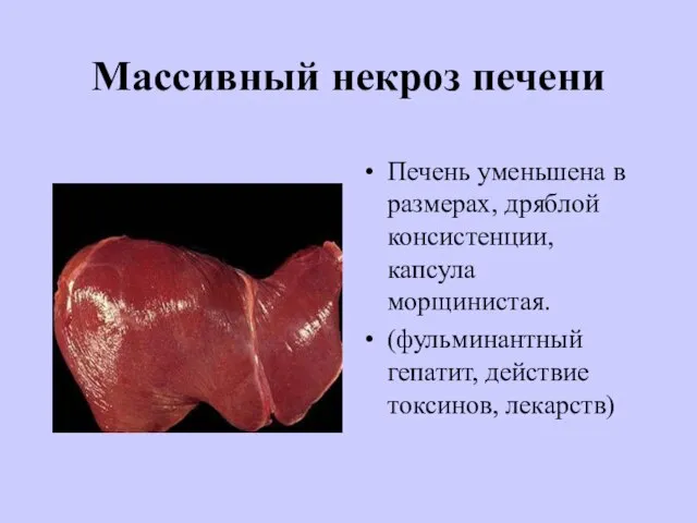 Массивный некроз печени Печень уменьшена в размерах, дряблой консистенции, капсула морщинистая. (фульминантный гепатит, действие токсинов, лекарств)