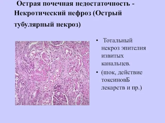 Острая почечная недостаточность - Некротический нефроз (Острый тубулярный некроз) Тотальный некроз эпителия