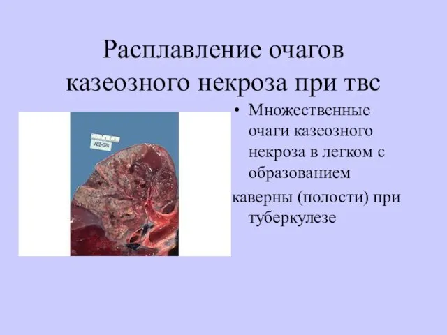 Расплавление очагов казеозного некроза при твс Множественные очаги казеозного некроза в легком