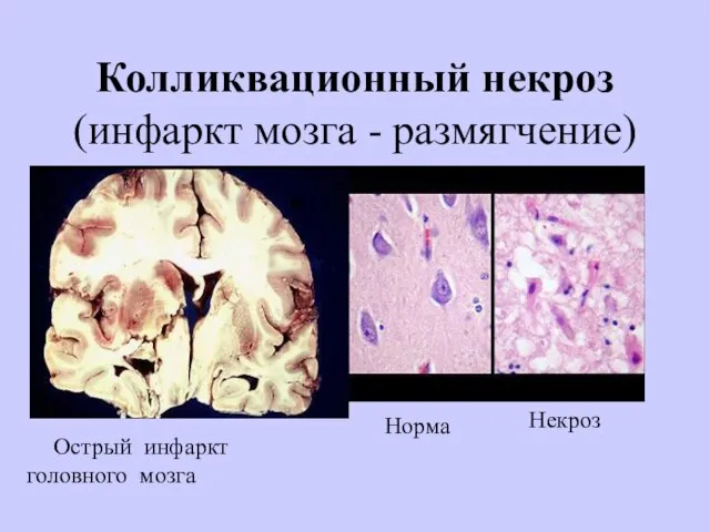 Колликвационный некроз (инфаркт мозга - размягчение) Острый инфаркт головного мозга Норма Некроз