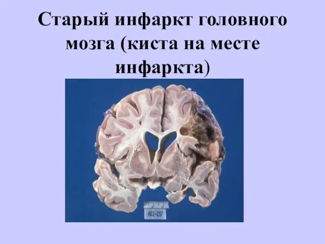 Старый инфаркт головного мозга (киста на месте инфаркта)