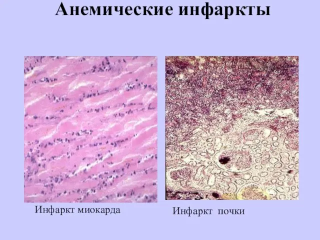 Анемические инфаркты Инфаркт миокарда Инфаркт почки