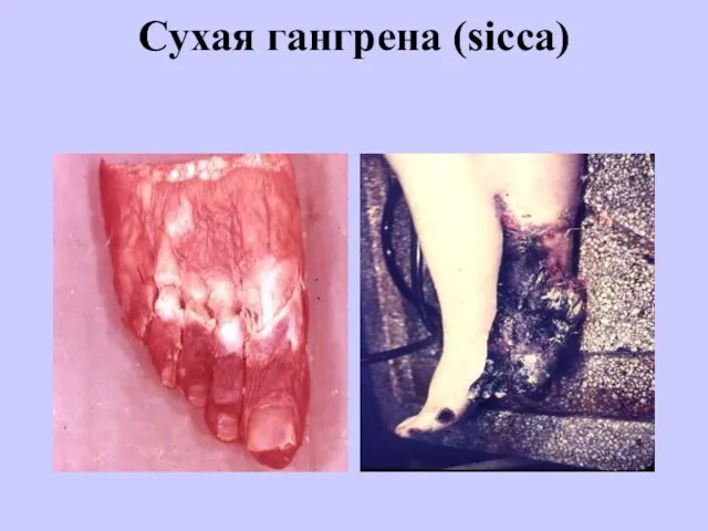 Сухая гангрена (sicca)