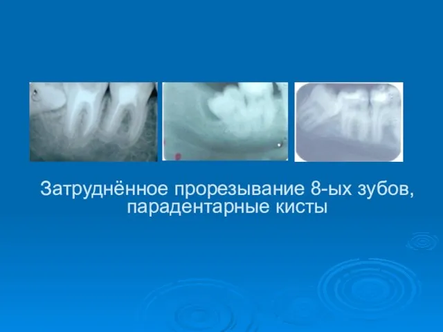 Затруднённое прорезывание 8-ых зубов, парадентарные кисты