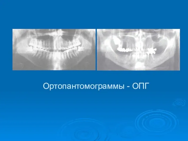 Ортопантомограммы - ОПГ