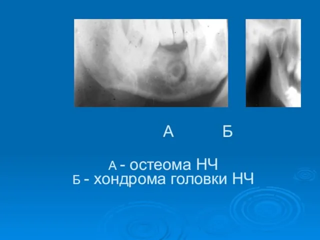 А - остеома НЧ Б - хондрома головки НЧ А Б