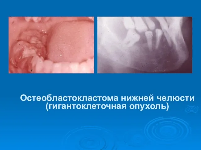 Остеобластокластома нижней челюсти (гигантоклеточная опухоль)