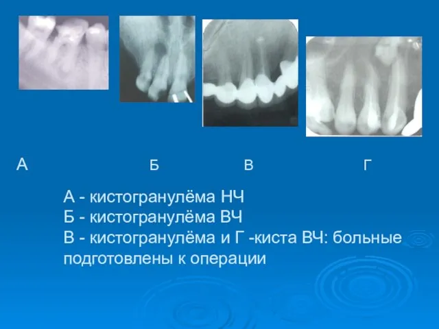 А - кистогранулёма НЧ Б - кистогранулёма ВЧ В - кистогранулёма и