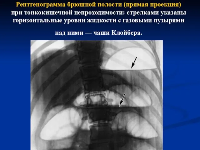 Рентгенограмма брюшной полости (прямая проекция) при тонкокишечной непроходимости: стрелками указаны горизонтальные уровни