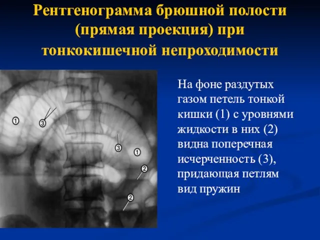 Рентгенограмма брюшной полости (прямая проекция) при тонкокишечной непроходимости На фоне раздутых газом