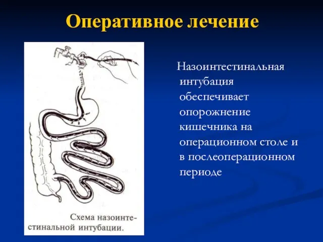 Оперативное лечение Назоинтестинальная интубация обеспечивает опорожнение кишечника на операционном столе и в послеоперационном периоде