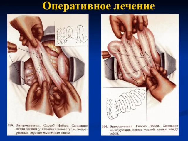 Оперативное лечение