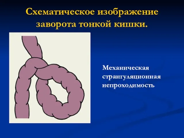 Схематическое изображение заворота тонкой кишки. Механическая странгуляционная непроходимость