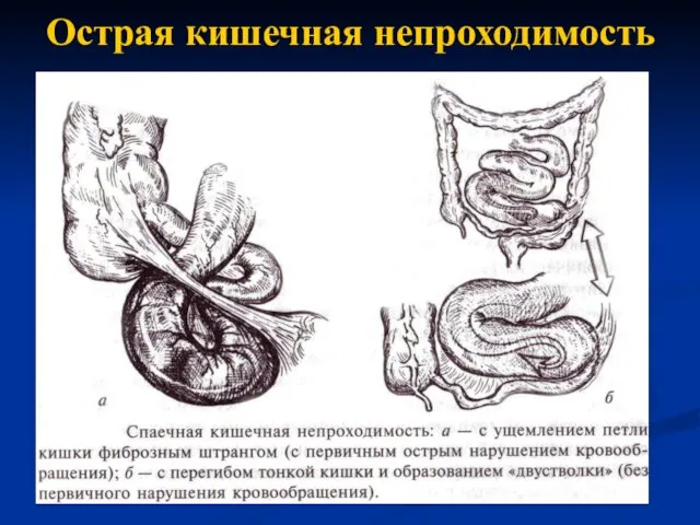 Острая кишечная непроходимость