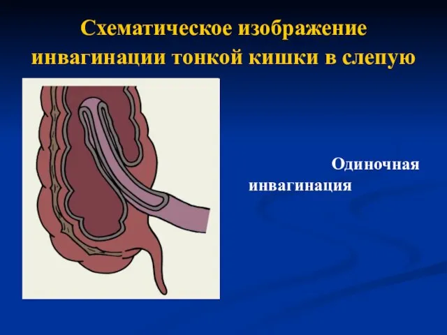 Схематическое изображение инвагинации тонкой кишки в слепую Одиночная инвагинация