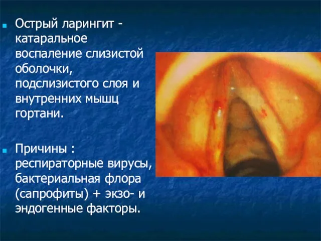 Острый ларингит - катаральное воспаление слизистой оболочки, подслизистого слоя и внутренних мышц