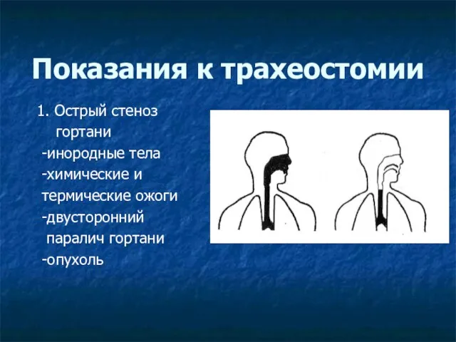 Показания к трахеостомии 1. Острый стеноз гортани -инородные тела -химические и термические