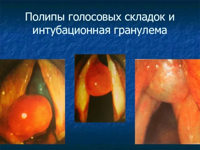 Полипы голосовых складок и интубационная гранулема