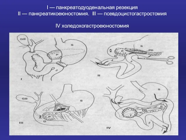 I — панкреатодуоденальная резекция II — панкреатикоеюностомия. Ill — псевдоцистогастростомия IV холедохогастроеюностомия