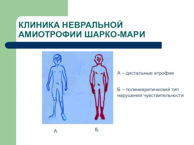 КЛИНИКА НЕВРАЛЬНОЙ АМИОТРОФИИ ШАРКО-МАРИ А Б А – дистальные атрофии Б – полиневритический тип нарушения чувствительности