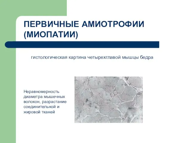 Неравномерность диаметра мышечных волокон, разрастание соединительной и жировой тканей ПЕРВИЧНЫЕ АМИОТРОФИИ (МИОПАТИИ)