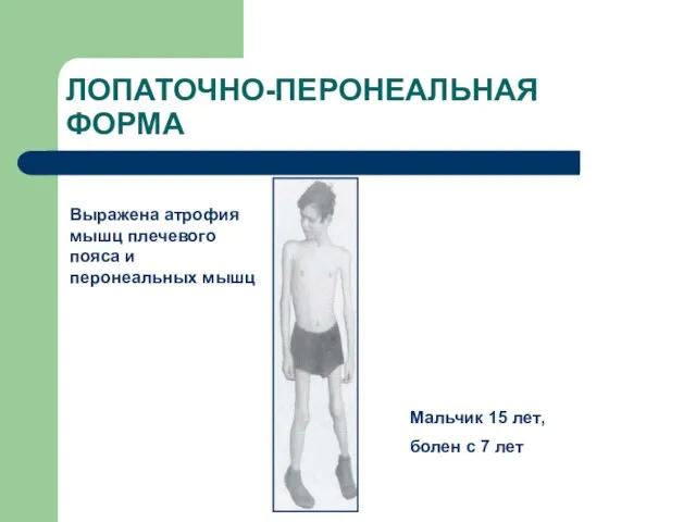 ЛОПАТОЧНО-ПЕРОНЕАЛЬНАЯ ФОРМА Выражена атрофия мышц плечевого пояса и перонеальных мышц Мальчик 15