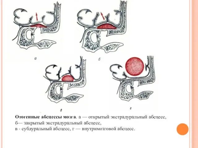 Отогенные абсцессы мозга. а — открытый экстрадуральный абсцесс, б— закрытый экстрадуральный абсцесс,