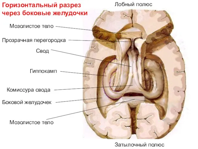 Горизонтальный разрез через боковые желудочки Гиппокамп Комиссура свода Свод Мозолистое тело Боковой