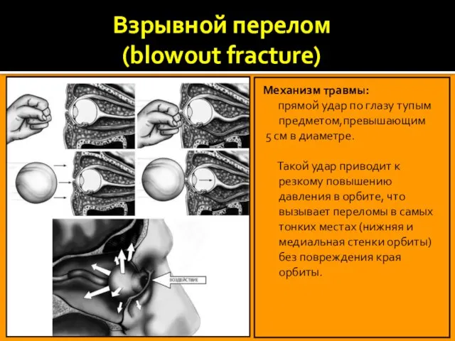 Взрывной перелом (blowout fracture) Механизм травмы: прямой удар по глазу тупым предметом,превышающим