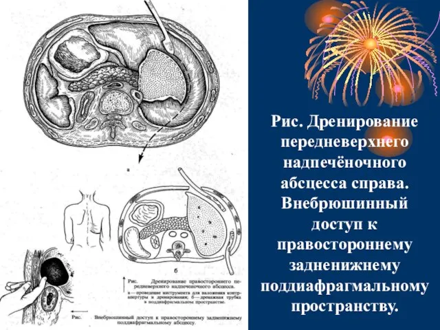 Рис. Дренирование передневерхнего надпечёночного абсцесса справа. Внебрюшинный доступ к правостороннему задненижнему поддиафрагмальному пространству.