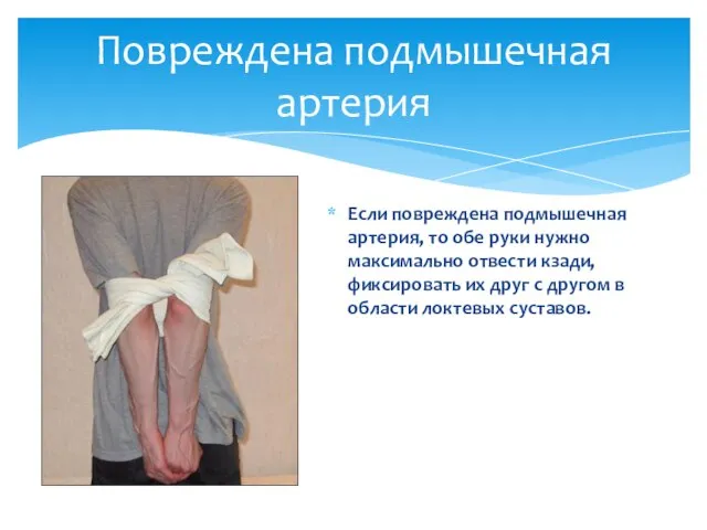 Если повреждена подмышечная артерия, то обе руки нужно максимально отвести кзади, фиксировать