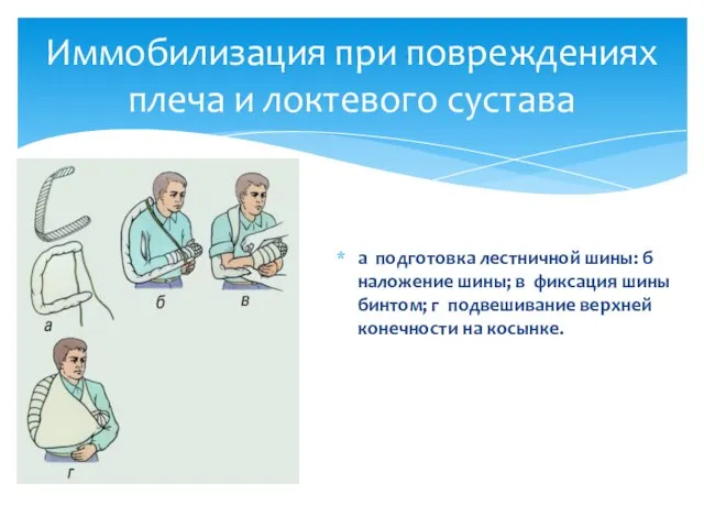 а подготовка лестничной шины: б наложение шины; в фиксация шины бинтом; г