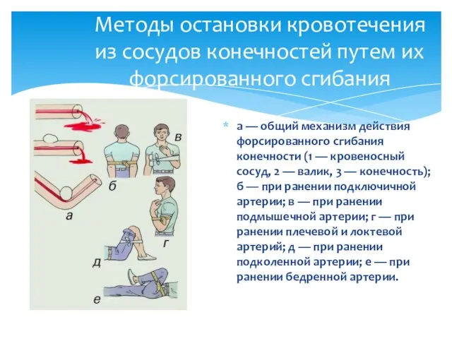 а — общий механизм действия форсированного сгибания конечности (1 — кровеносный сосуд,