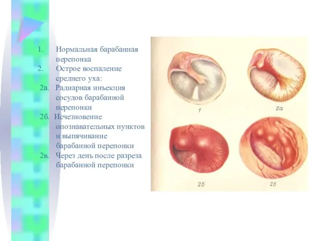 Нормальная барабанная перепонка Острое воспаление среднего уха: 2а. Радиарная инъекция сосудов барабанной