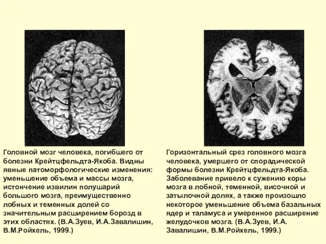 Головной мозг человека, погибшего от болезни Крейтцфельдта-Якоба. Видны явные патоморфологические изменения: уменьшение