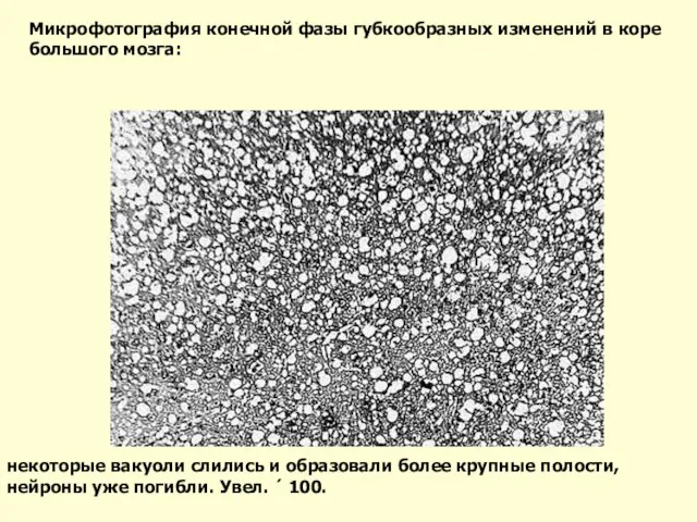 некоторые вакуоли слились и образовали более крупные полости, нейроны уже погибли. Увел.