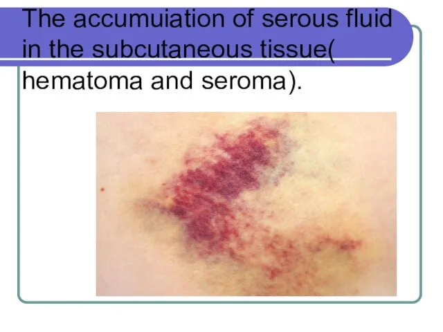 The accumuiation of serous fluid in the subcutaneous tissue( hematoma and seroma).