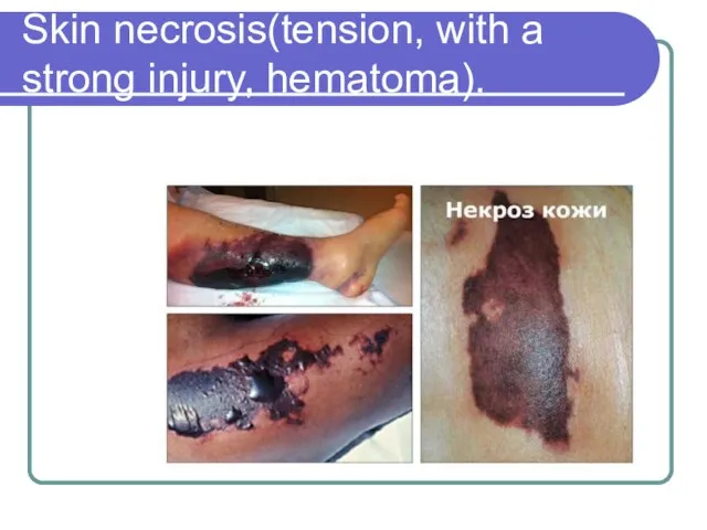 Skin necrosis(tension, with a strong injury, hematoma).