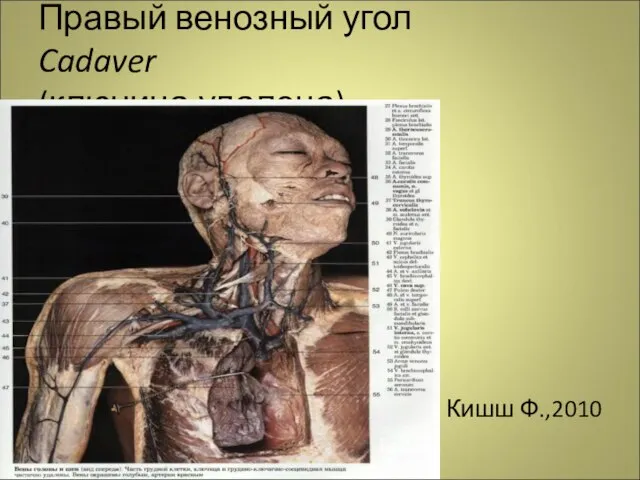 Правый венозный угол Cadaver (ключица удалена) Кишш Ф.,2010