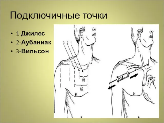 Подключичные точки 1-Джилес 2-Аубаниак 3-Вильсон