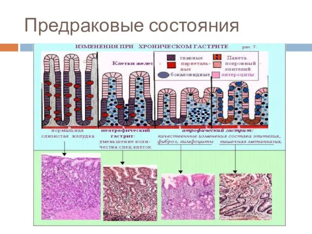 Предраковые состояния