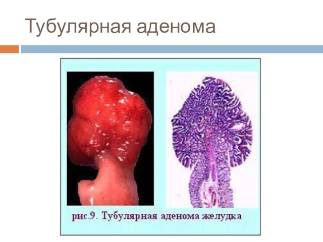 Тубулярная аденома