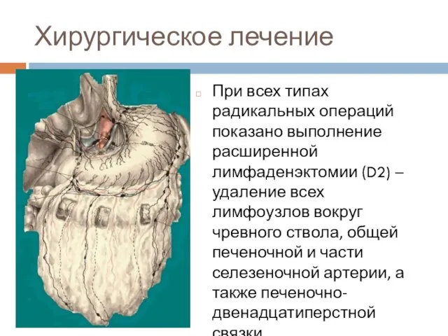 Хирургическое лечение При всех типах радикальных операций показано выполнение расширенной лимфаденэктомии (D2)