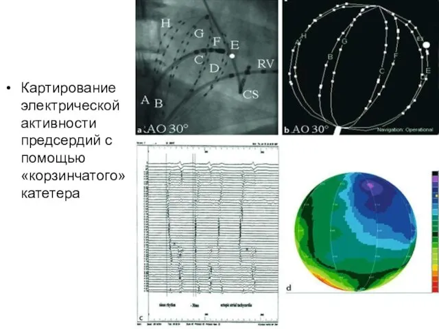 Картирование электрической активности предсердий с помощью «корзинчатого» катетера