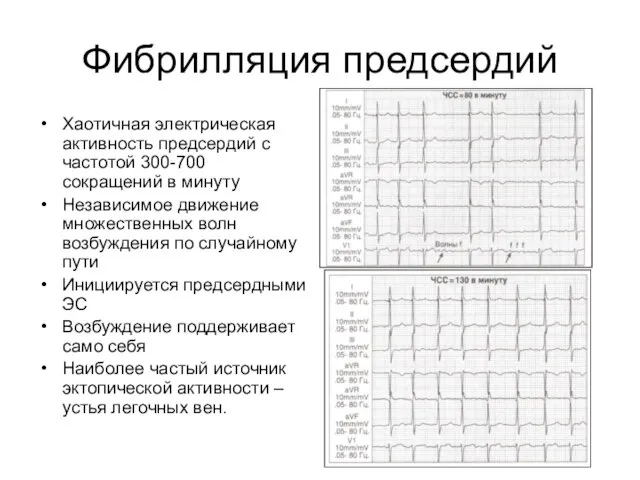 Фибрилляция предсердий Хаотичная электрическая активность предсердий с частотой 300-700 сокращений в минуту