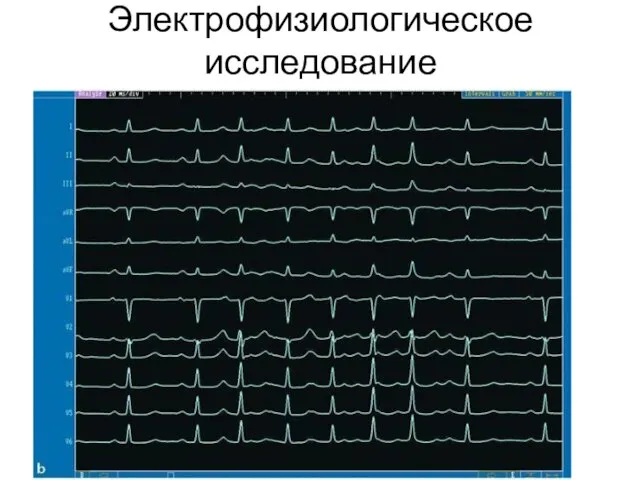 Электрофизиологическое исследование