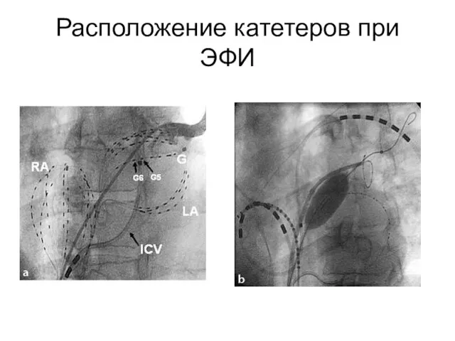 Расположение катетеров при ЭФИ