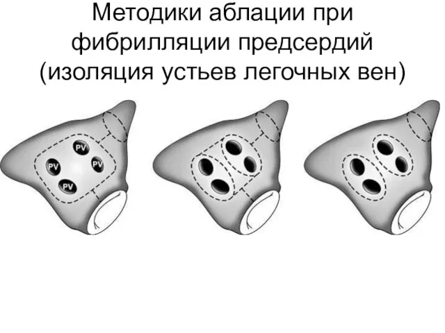 Методики аблации при фибрилляции предсердий (изоляция устьев легочных вен)